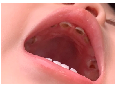 河北惟德口腔涂氟流程簡(jiǎn)單，孩子配合度拉滿(mǎn)