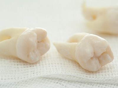 智齒疼了，這牙非拔不可嗎？