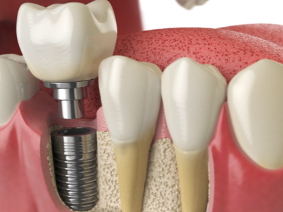 選擇種植牙后要做哪些日常維護？