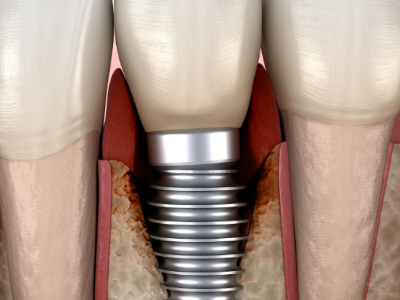 種植牙的術(shù)前準(zhǔn)備有哪些？