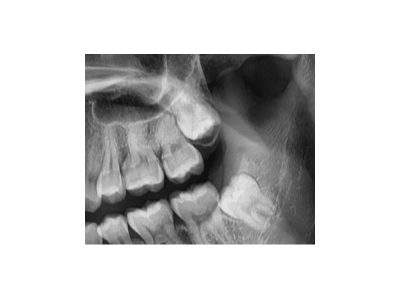 既然「智齒」不宜久留，為什么不能一次性拔掉？