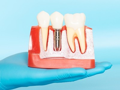 種牙VS鑲牙，你適合哪種?