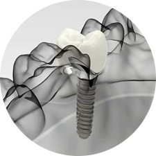 術(shù)前研究、模擬提升種植成功率