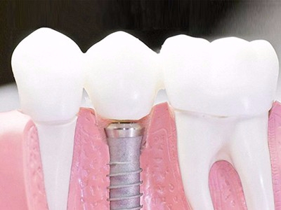 在承德口腔種植齒需要多少錢？惟德口腔一一為您道來