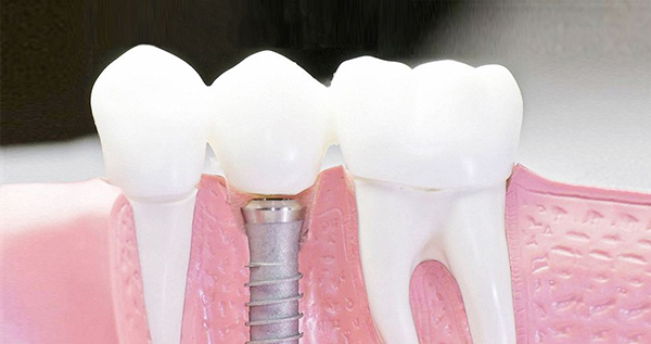 在承德口腔種植牙齒需要多少錢？惟德口腔一一為您道來