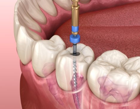 根管治療后的注意事項(xiàng)有哪些？
